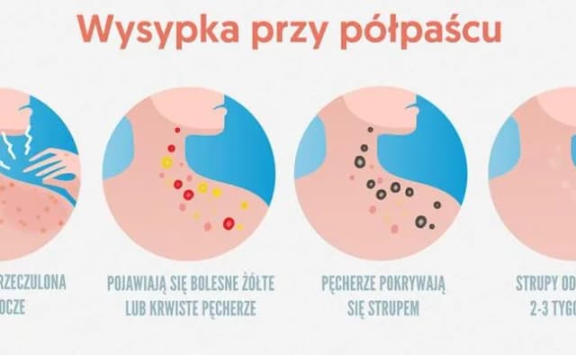 Półpasiec objawy u dziecka: Jak rozpoznać i uniknąć powikłań Półpasiec objawy u dziecka: Jak rozpoznać i uniknąć powikłań